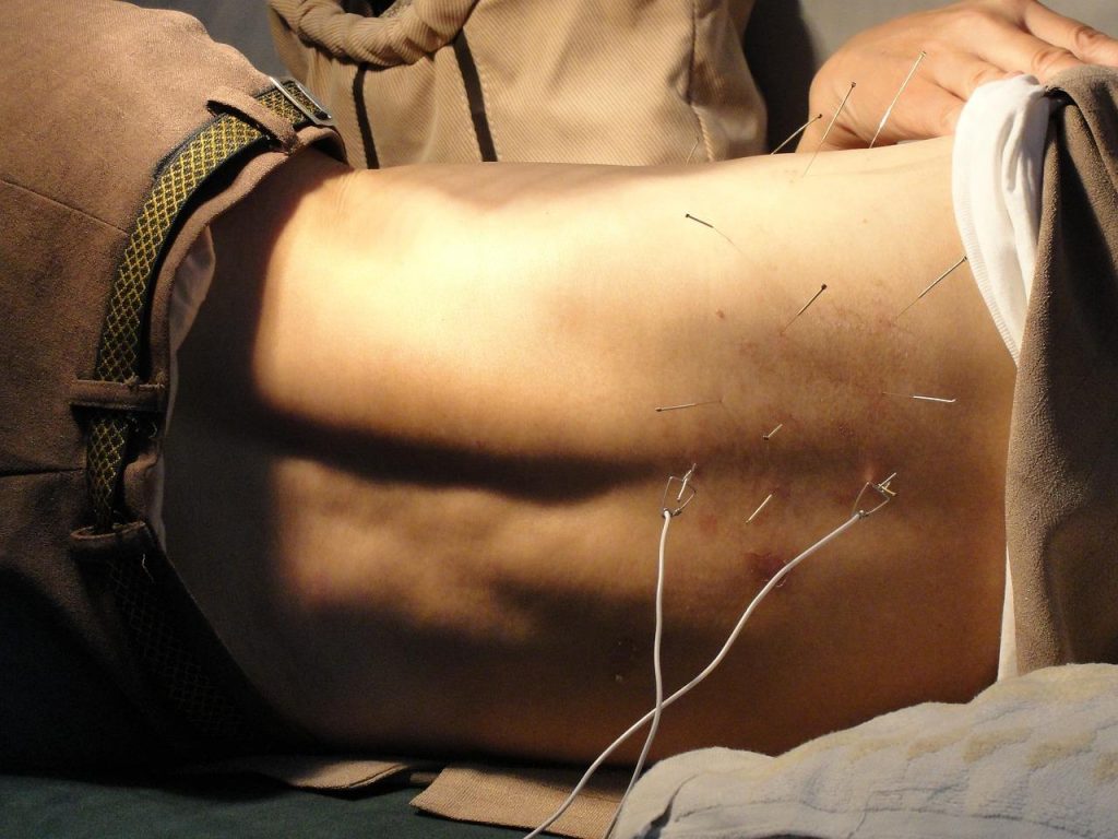 Acupuncturist voert acupunctuurbehandeling uit met dunne naalden voor pijnverlichting en welzijn